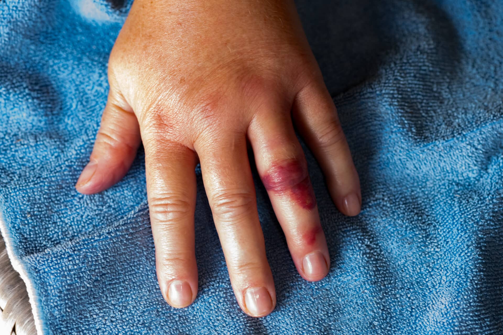Eine Hand 24 h nach dem Stich durch eine Arbeiterin der Asiatischen Hornisse. Die Schwellung ist bereits am Abklingen. Auffällig ist die Verfärbung des Ringfingers, die sich erst einen Tag nach dem Stich einstellte und im Krankenhaus mit Cortison behandelt wurde.